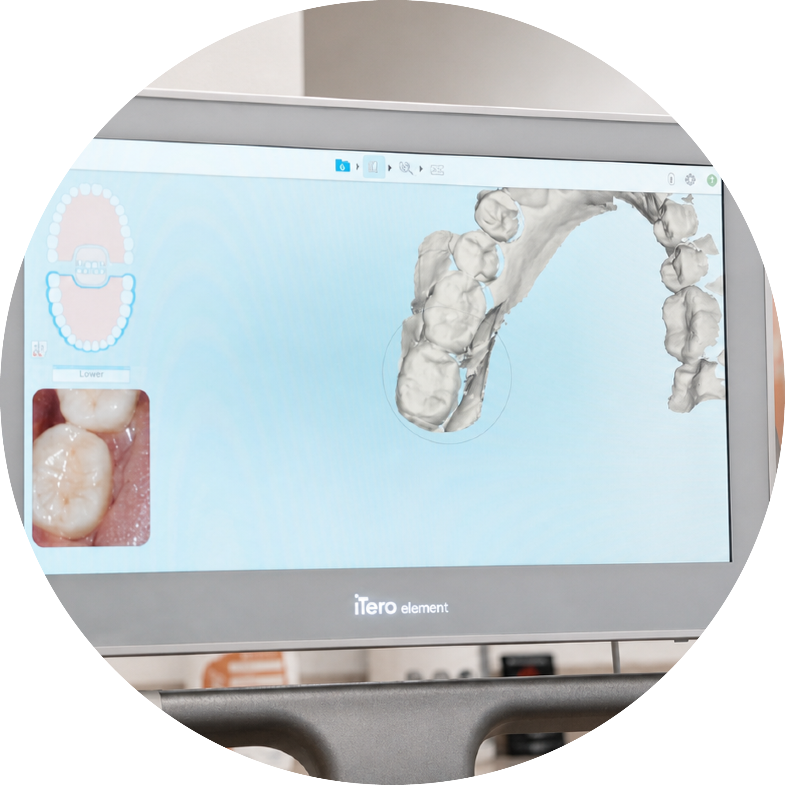 3D dental scan on iTero element at Keller & Wainwright Orthodontics in Sunnyvale, CA