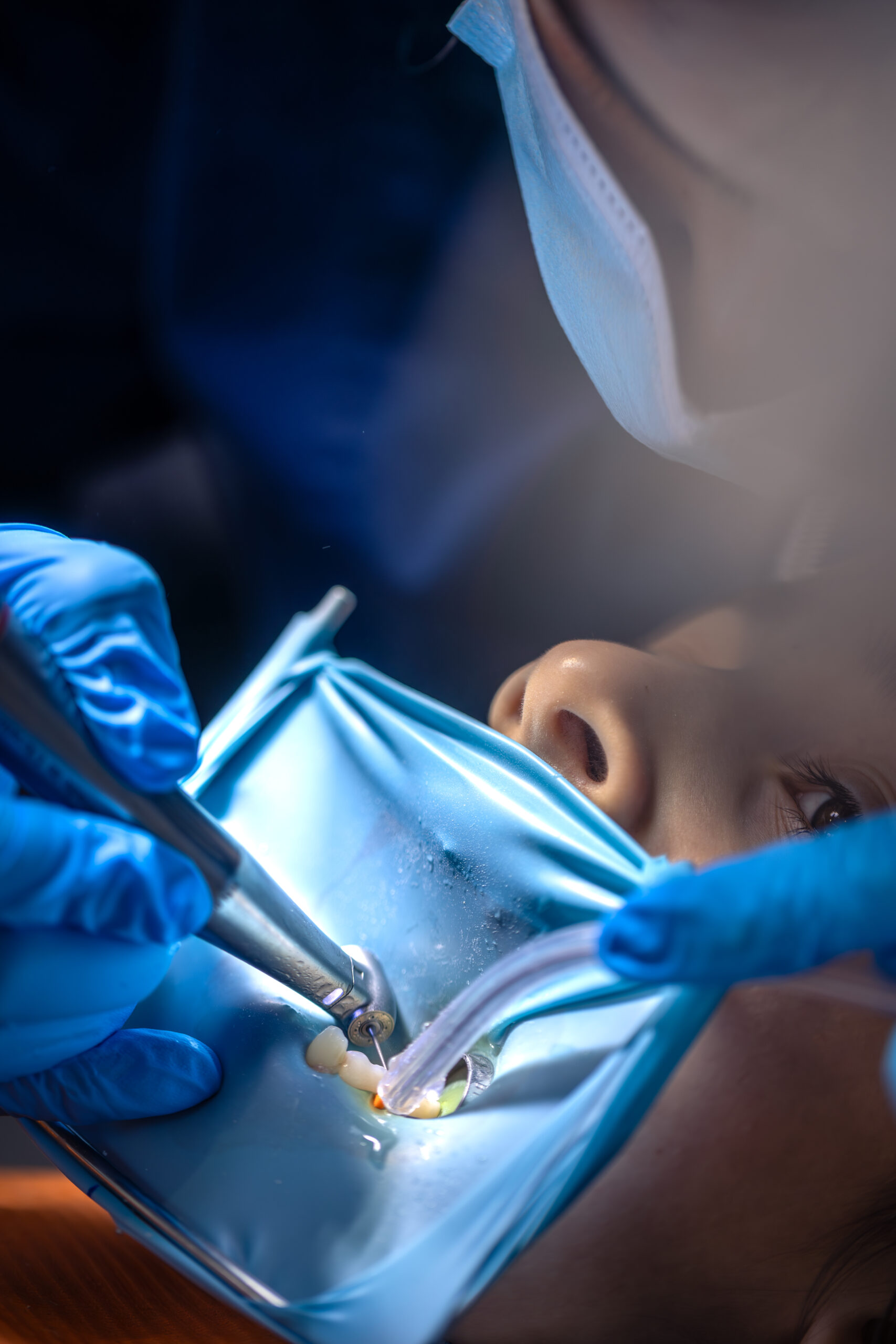 Dental procedure at Keller & Wainwright Orthodontics in Sunnyvale, CA with blue dental dam